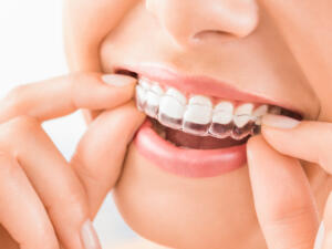 Les Aligneurs Orthodontiques Praticien