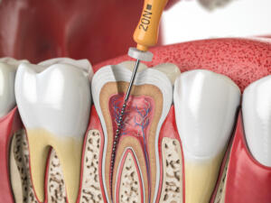 Perfectionnement en Endodontie